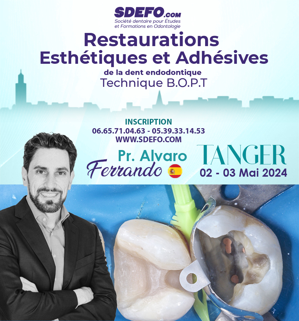 Restaurations  Esthétiques et Adhésives de la dent endodontique « Technique B.O.P.T « 